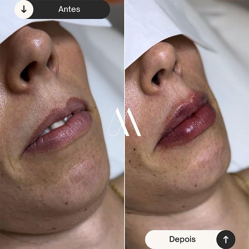 Preenchimento Labial