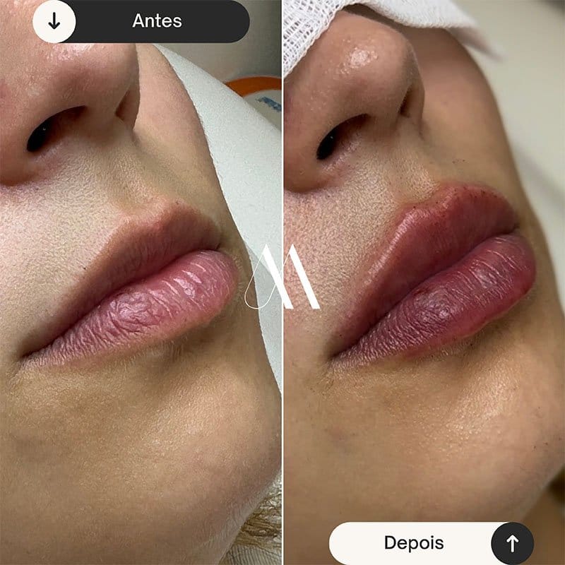 Preenchimento Labial