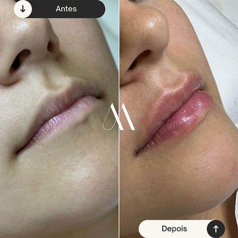 Preenchimento Labial