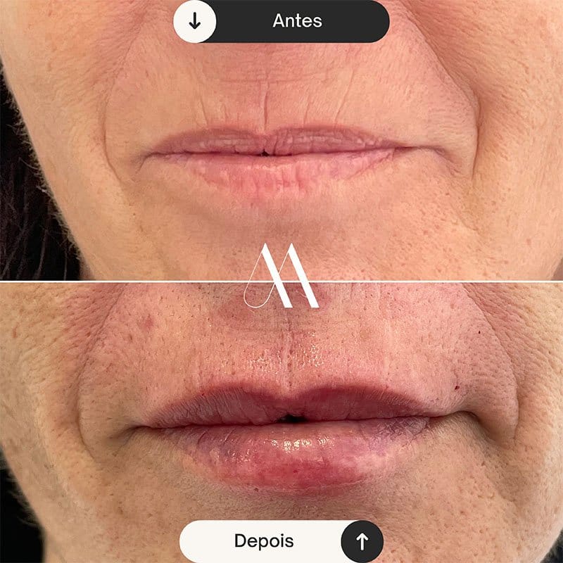 Preenchimento Labial e correção de código de barras