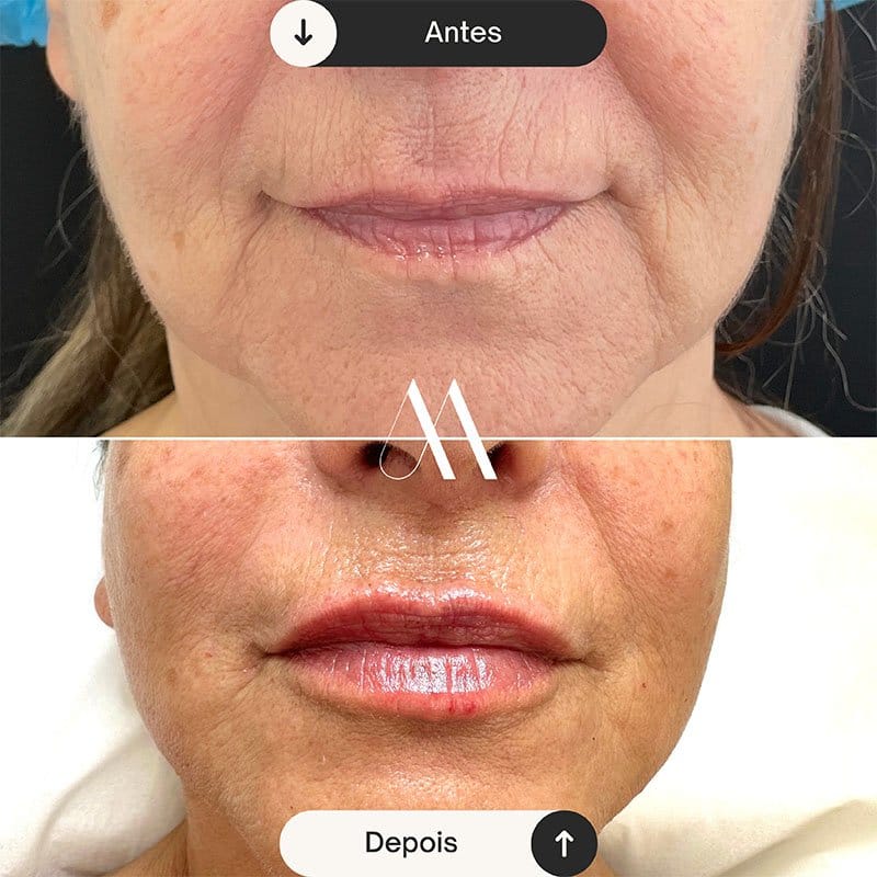 Preenchimento Labial e correção de código de barras