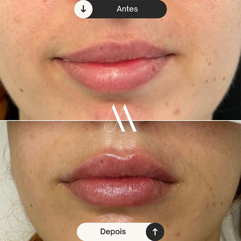 Preenchimento Labial