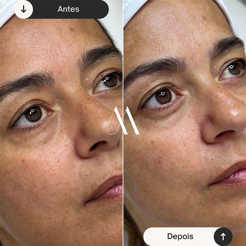 Preenchimento de olheira