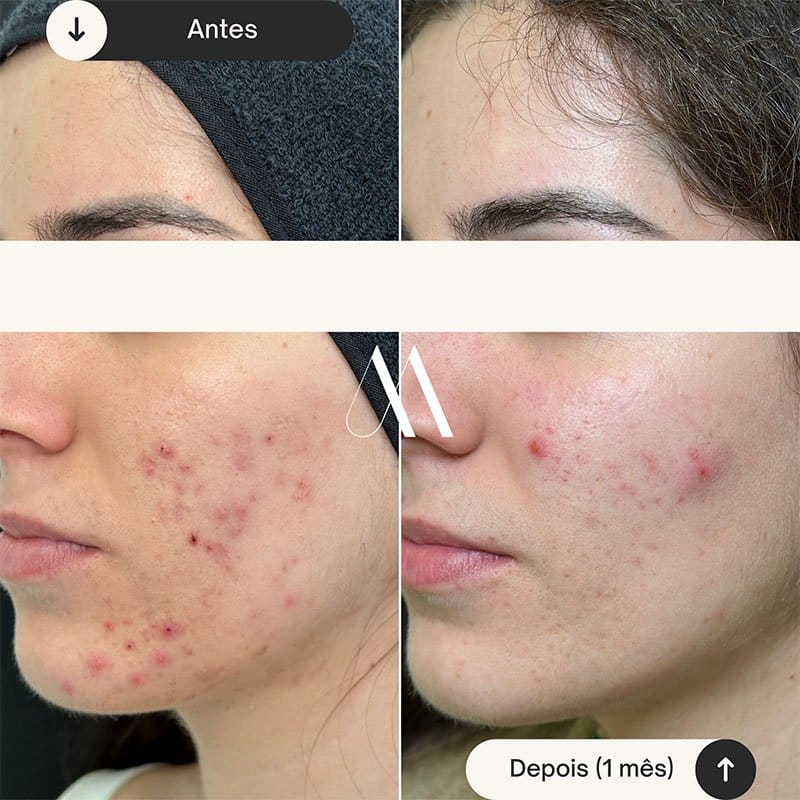 SkinCare Acne