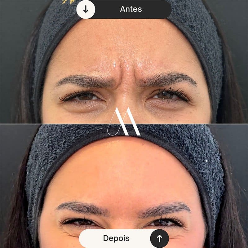 Toxina Botulínica - Glabela