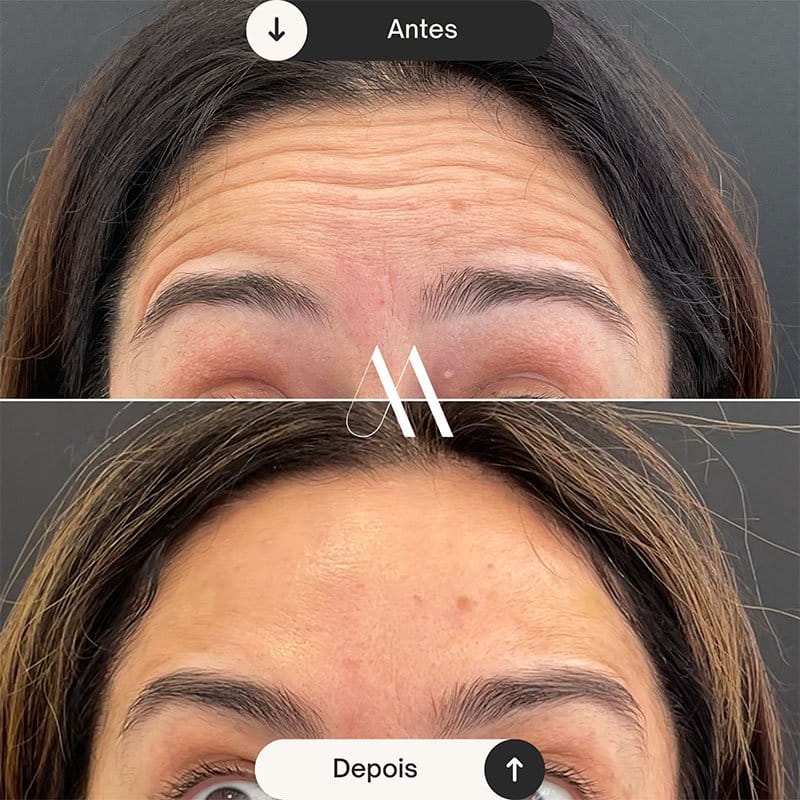 Toxina Botulínica - Testa