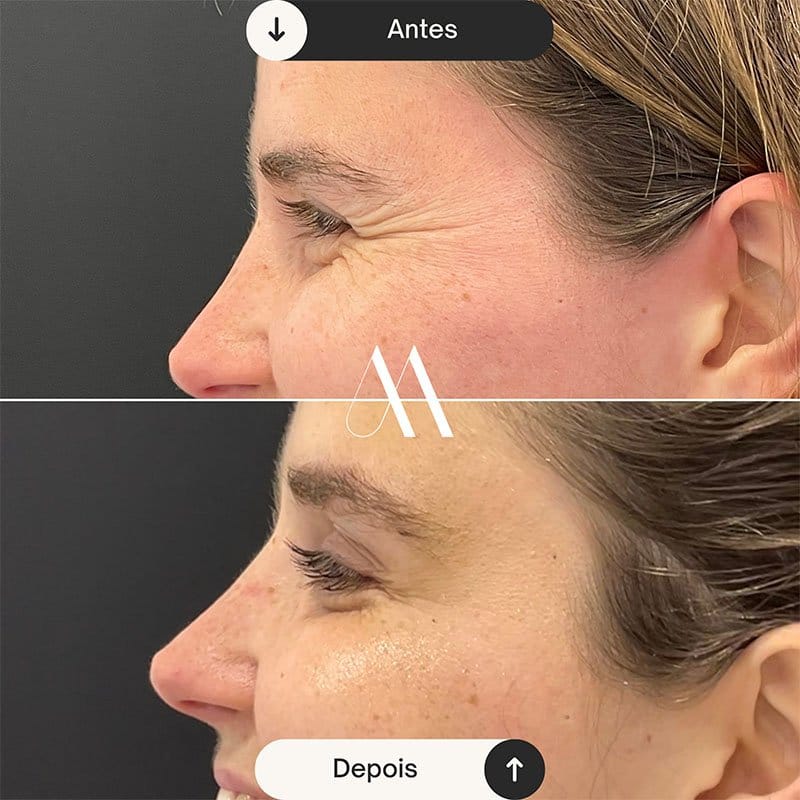 Toxina Botulínica - Pés de Galinha