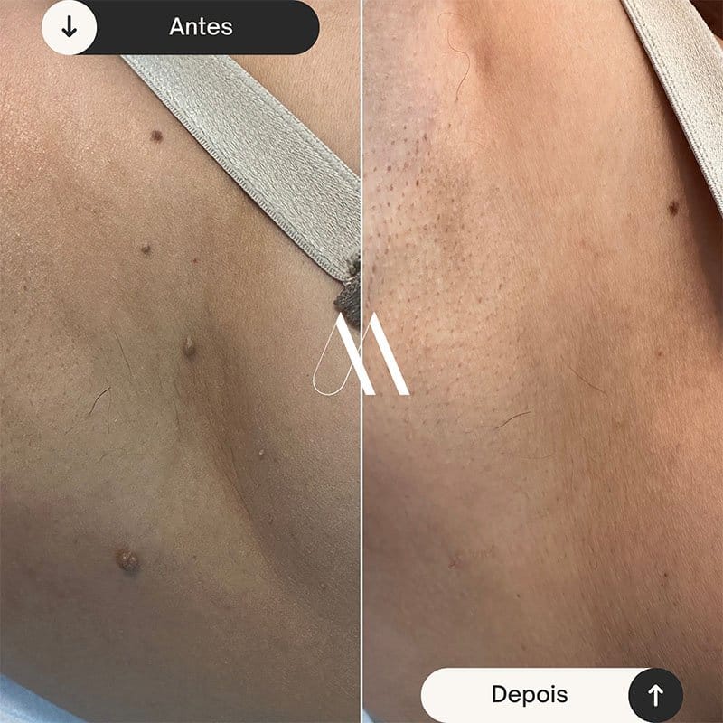 Remoção de fibromas